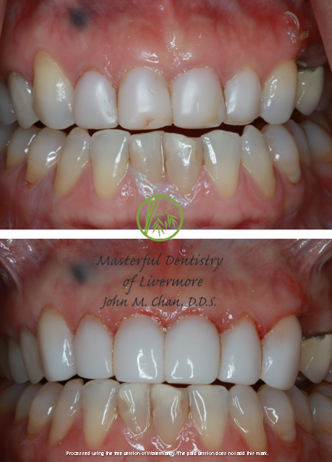 Bioclear case 1 — black triangle closure