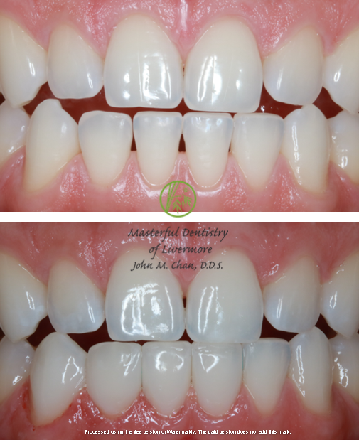 Bioclear case 10 — discoloration and gaps