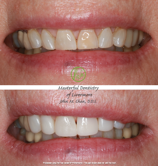 Bioclear case 11 — uneven teeth