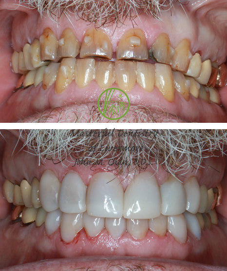 Bioclear case 12 — smile symmetry