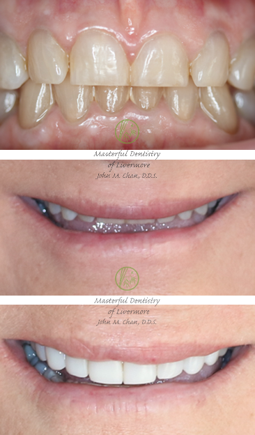 Bioclear case 14 — black triangle treatment