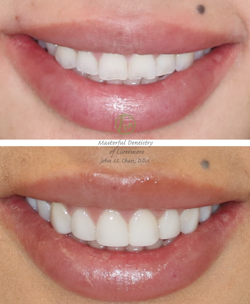 Bioclear case 15 — composite reshaping