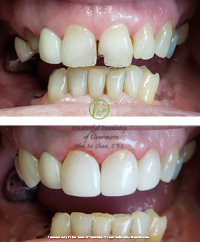 Bioclear case 2 — chipped teeth restored