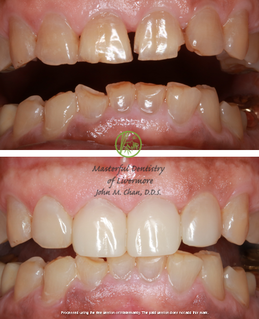 Bioclear case 6 — chip repair