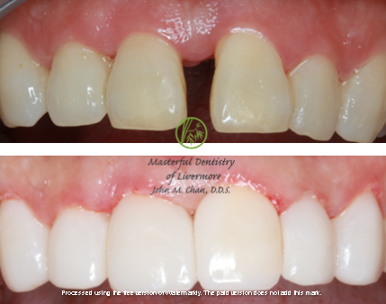 Bioclear case 7 — diastema closure