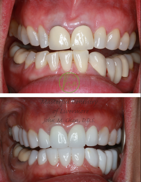 Crown case 1 — porcelain crown restoration